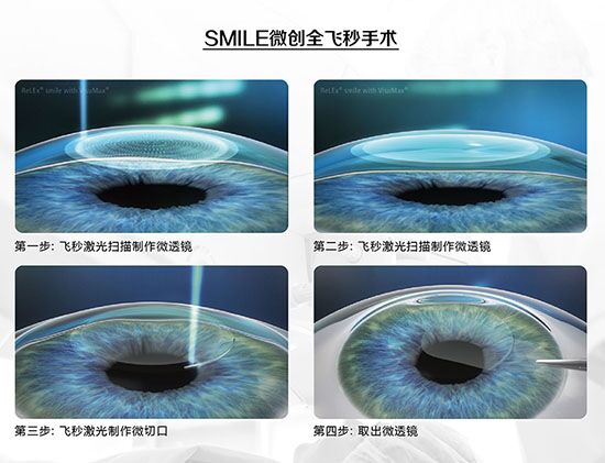 蔡司全飛秒、蔡司半飛秒近視手術(shù)與宇航飛秒的區(qū)別